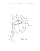 SYSTEMS AND METHODS FOR PERFORMING MINIMALLY INVASIVE PROCEDURES diagram and image