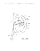 SYSTEMS AND METHODS FOR PERFORMING MINIMALLY INVASIVE PROCEDURES diagram and image