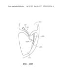 SYSTEMS AND METHODS FOR PERFORMING MINIMALLY INVASIVE PROCEDURES diagram and image