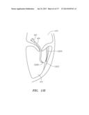 SYSTEMS AND METHODS FOR PERFORMING MINIMALLY INVASIVE PROCEDURES diagram and image