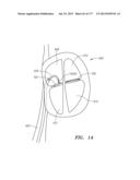 SYSTEMS AND METHODS FOR PERFORMING MINIMALLY INVASIVE PROCEDURES diagram and image