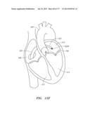 SYSTEMS AND METHODS FOR PERFORMING MINIMALLY INVASIVE PROCEDURES diagram and image