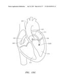 SYSTEMS AND METHODS FOR PERFORMING MINIMALLY INVASIVE PROCEDURES diagram and image