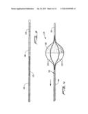 ROTATIONAL THROMBECTOMY WIRE WITH BLOCKING DEVICE diagram and image