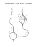 ROTATIONAL THROMBECTOMY WIRE WITH BLOCKING DEVICE diagram and image