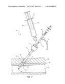 BIOADHESIVE DELIVERY CATHETER MANIFOLD WITH MIXING FIXTURE AND METHODS diagram and image