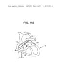 SINGLE DISC OCCLUSIONARY PATENT FORAMEN OVALE CLOSURE DEVICE diagram and image