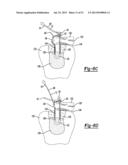 Apparatus For Coupling Soft Tissue To A Bone diagram and image