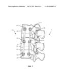 VERTEBRAL FASTENER SYSTEM diagram and image