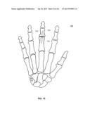 System and Method for Bone Fixation diagram and image