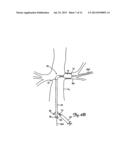 EMBOLIC PROTECTION SYSTEMS FOR BIFURCATED CONDUITS diagram and image