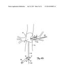 EMBOLIC PROTECTION SYSTEMS FOR BIFURCATED CONDUITS diagram and image