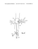 EMBOLIC PROTECTION SYSTEMS FOR BIFURCATED CONDUITS diagram and image