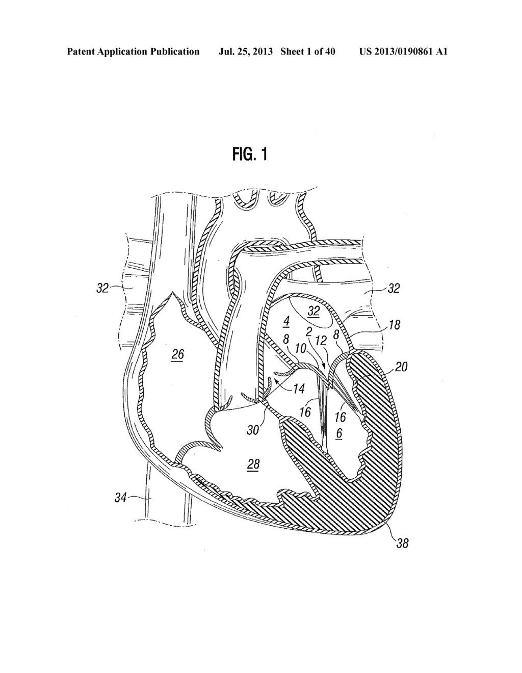 Prosthetic Valve for Replacing Mitral Valve - diagram, schematic, and image 02