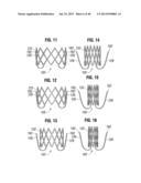 Prosthetic Valve for Replacing Mitral Valve diagram and image