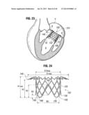 Prosthetic Valve for Replacing Mitral Valve diagram and image