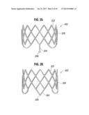 Prosthetic Valve for Replacing Mitral Valve diagram and image