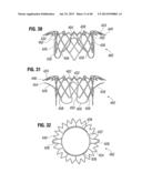 Prosthetic Valve for Replacing Mitral Valve diagram and image