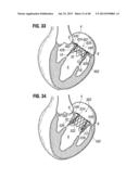 Prosthetic Valve for Replacing Mitral Valve diagram and image