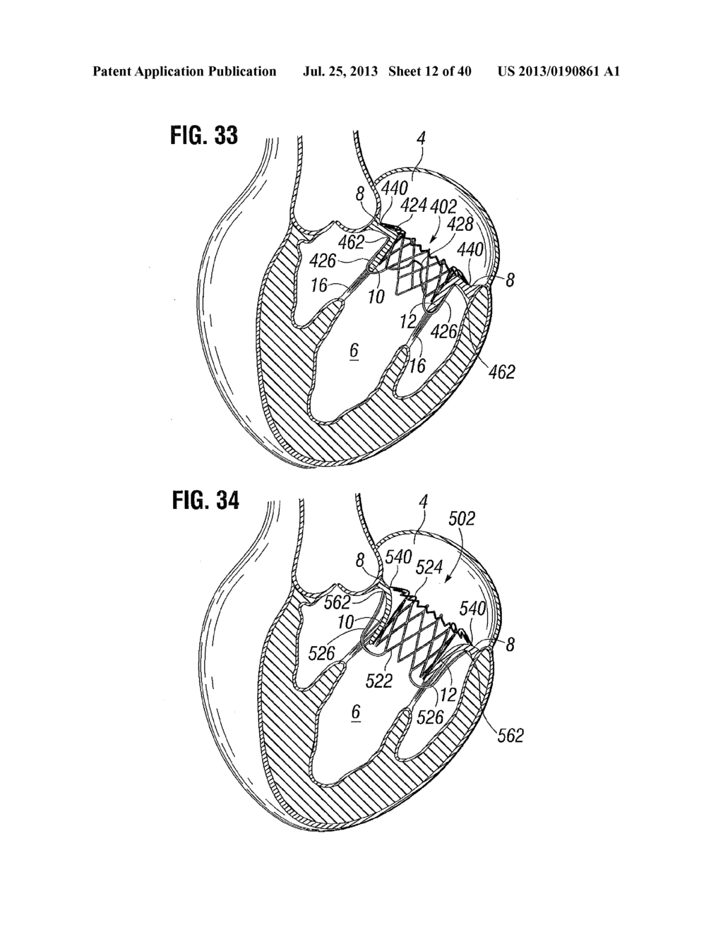 Prosthetic Valve for Replacing Mitral Valve - diagram, schematic, and image 13