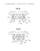 Prosthetic Valve for Replacing Mitral Valve diagram and image