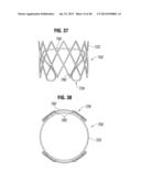 Prosthetic Valve for Replacing Mitral Valve diagram and image