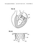 Prosthetic Valve for Replacing Mitral Valve diagram and image