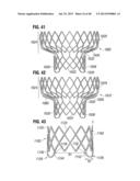 Prosthetic Valve for Replacing Mitral Valve diagram and image