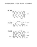 Prosthetic Valve for Replacing Mitral Valve diagram and image