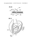 Prosthetic Valve for Replacing Mitral Valve diagram and image