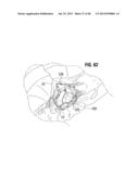 Prosthetic Valve for Replacing Mitral Valve diagram and image