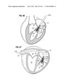 Prosthetic Valve for Replacing Mitral Valve diagram and image