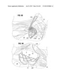 Prosthetic Valve for Replacing Mitral Valve diagram and image