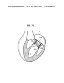 Prosthetic Valve for Replacing Mitral Valve diagram and image