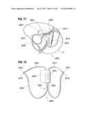 Prosthetic Valve for Replacing Mitral Valve diagram and image