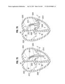 Prosthetic Valve for Replacing Mitral Valve diagram and image