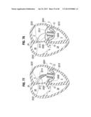 Prosthetic Valve for Replacing Mitral Valve diagram and image