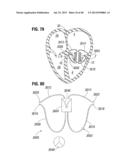 Prosthetic Valve for Replacing Mitral Valve diagram and image