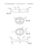 SHEATHS FOR EXTRA-ARTICULAR IMPLANTABLE SYSTEMS diagram and image