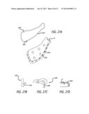 SHEATHS FOR EXTRA-ARTICULAR IMPLANTABLE SYSTEMS diagram and image