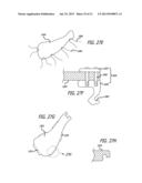 SHEATHS FOR EXTRA-ARTICULAR IMPLANTABLE SYSTEMS diagram and image