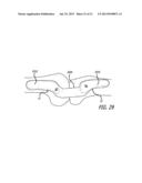 SHEATHS FOR EXTRA-ARTICULAR IMPLANTABLE SYSTEMS diagram and image