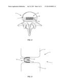 EXPANDABLE INTERBODY IMPLANT AND METHODS OF USE diagram and image