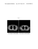 USE OF INHIBITORS OF BRUTON S TYROSINE KINASE (BTK) diagram and image