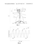 NEURAL MONITORING METHODS AND SYSTEMS FOR TREATING UPPER AIRWAY DISORDERS diagram and image