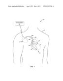 AUTOMATIC SELECTION OF ELECTRODE VECTORS FOR ASSESSING RISK OF HEART     FAILURE DECOMPENSATION EVENTS diagram and image