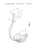 AUTOMATIC SELECTION OF ELECTRODE VECTORS FOR ASSESSING RISK OF HEART     FAILURE DECOMPENSATION EVENTS diagram and image