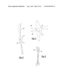 Patient-Specific Knee Alignment Guide And Associated Method diagram and image