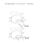 Patient-Specific Knee Alignment Guide And Associated Method diagram and image