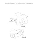 Patient-Specific Knee Alignment Guide And Associated Method diagram and image